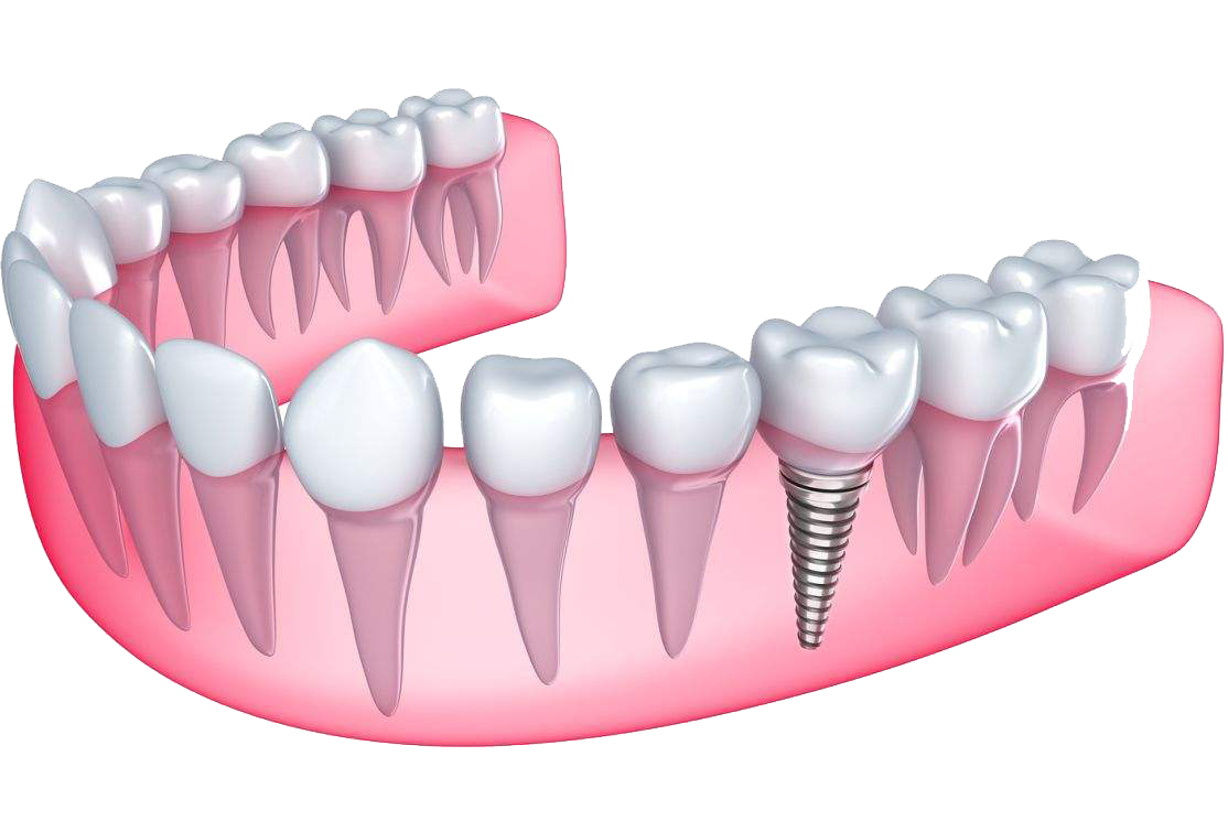 bolu diş implant